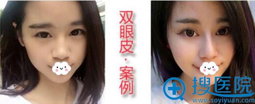 <!--<i data=20240710 data-id=12616></i>-->park双眼皮+开内眼角案例 <!--<i data=20240710 data-id=12616></i>-->park双眼皮+开内眼角案例