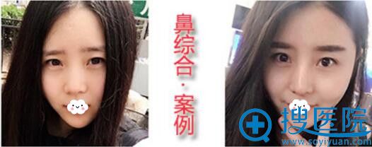 <!--<i data=20240710 data-id=12616></i>-->综合隆鼻效果前后对比 <!--<i data=20240710 data-id=12616></i>-->综合隆鼻效果前后对比