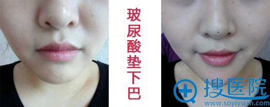 <!--<i data=20240710 data-id=12616></i>-->玻尿酸垫下巴真人案例 <!--<i data=20240710 data-id=12616></i>-->玻尿酸垫下巴真人案例