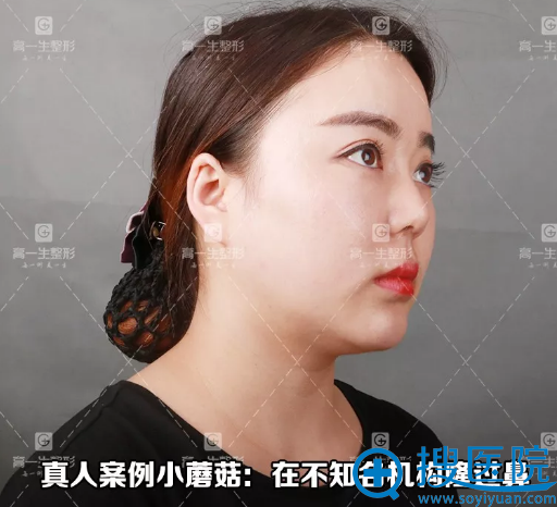 隆鼻失败后的照片 隆鼻失败后的照片