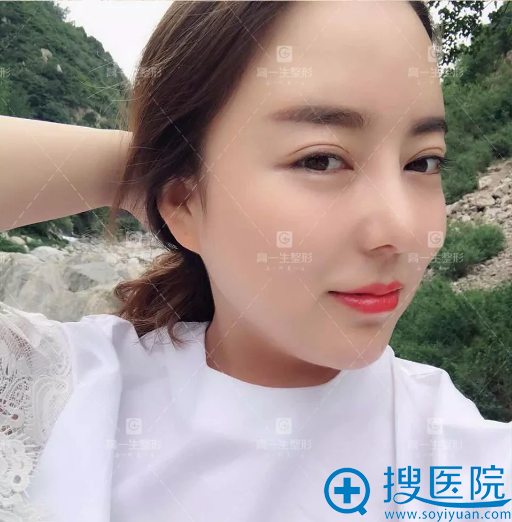 找西安高一生金磊做完隆鼻失败修复的生活照 找西安高一生金磊做完隆鼻失败修复的生活照