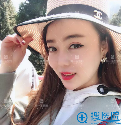 西安高一生金磊隆鼻失败修复案例效果图 西安高一生金磊隆鼻失败修复案例效果图
