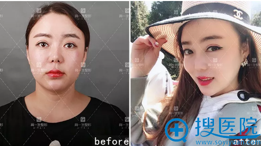 西安高一生金磊做的隆鼻失败修复案例对比图 西安高一生金磊做的隆鼻失败修复案例对比图