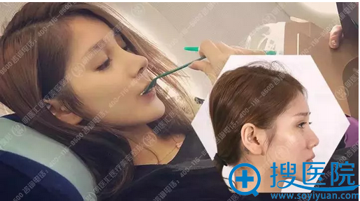 刚在大连明医汇找刘威做完肋软骨鼻综合隆鼻的妹子比金秘书还美