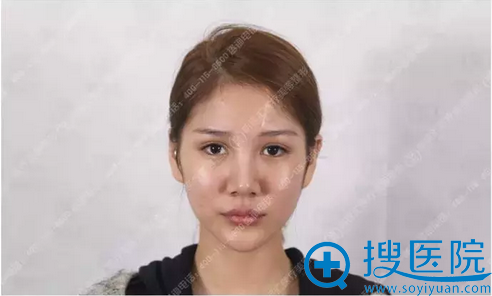 来大连明医汇做隆鼻前的照片 来大连明医汇做隆鼻前的照片