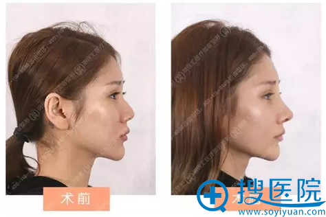 大连明医汇<!--<i data=20240710 data-id=16852></i>-->隆鼻前后对比图 大连明医汇<!--<i data=20240710 data-id=16852></i>-->隆鼻前后对比图