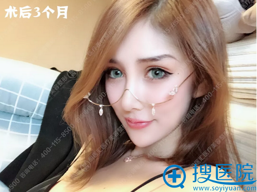 找大连明医汇<!--<i data=20240710 data-id=16852></i>-->做完肋软骨鼻综合隆鼻术后三个月图片 找大连明医汇<!--<i data=20240710 data-id=16852></i>-->做完肋软骨鼻综合隆鼻术后三个月图片
