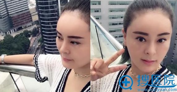 <!--<i data=20240710 data-id=12088></i>-->做假体隆鼻20天恢复照 <!--<i data=20240710 data-id=12088></i>-->做假体隆鼻20天恢复照