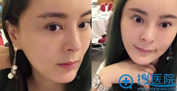 在熙而美做鼻综合术后60天 在熙而美做鼻综合术后60天