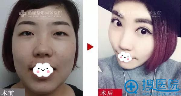 燕丽整形双眼皮真人案例术前术后效果 燕丽整形双眼皮真人案例术前术后效果