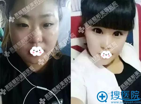 燕丽整形美容医院<单眼皮+内眦赘皮>眼部综合效果 燕丽整形美容医院<单眼皮+内眦赘皮>眼部综合效果