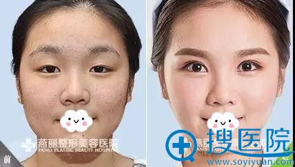 燕丽整形美容医院双眼皮真人案例前后对比 燕丽整形美容医院双眼皮真人案例前后对比
