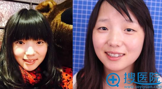 结合丽都于晓春和曹卫华真人案例我选择曹卫华割双眼皮和开眼角