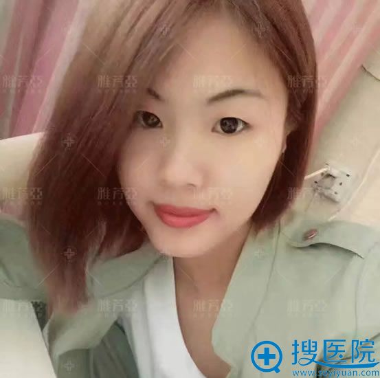 看闺蜜朋友圈晒雅芳亚做双眼皮效果和价格表找刘莎主任割双眼皮