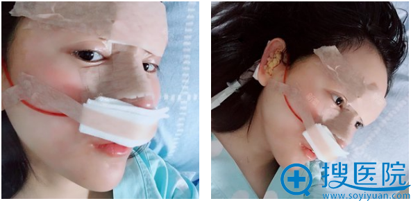 找郑州美莱丁建平做隆鼻失败修复天图片 找郑州美莱丁建平做隆鼻失败修复天图片