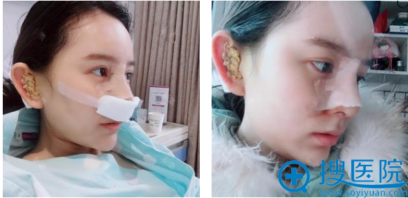 找郑州美莱丁建平做鼻修复术后五天恢复图片 找郑州美莱丁建平做鼻修复术后五天恢复图片
