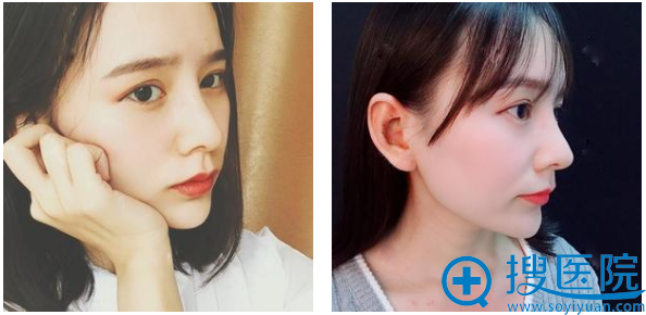 郑州美莱丁建平做的隆鼻修复术后一个月图片 郑州美莱丁建平做的隆鼻修复术后一个月图片