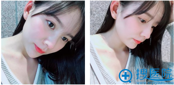 郑州美莱丁建平隆鼻失败修复术后两个月生活照 郑州美莱丁建平隆鼻失败修复术后两个月生活照