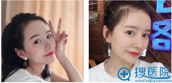 郑州美莱整形医院丁建平隆鼻修复案例术后两个月效果图 郑州美莱整形医院丁建平隆鼻修复案例术后两个月效果图