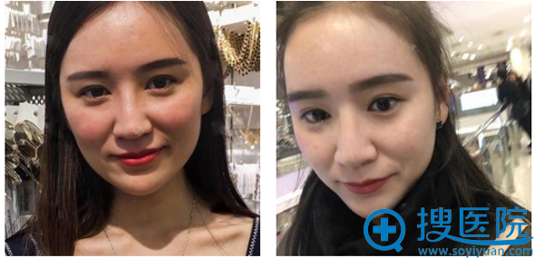 我也是对比了郑州天后和美莱才选择丁建平为我做隆鼻失败修复的