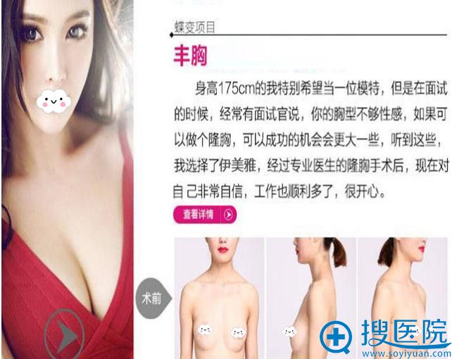 <!--<i data=20240710 data-id=9126></i>-->假体隆胸真人案例 <!--<i data=20240710 data-id=9126></i>-->假体隆胸真人案例