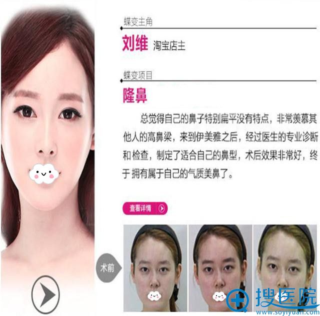 <!--<i data=20240710 data-id=9126></i>-->假体隆鼻效果对比 <!--<i data=20240710 data-id=9126></i>-->假体隆鼻效果对比