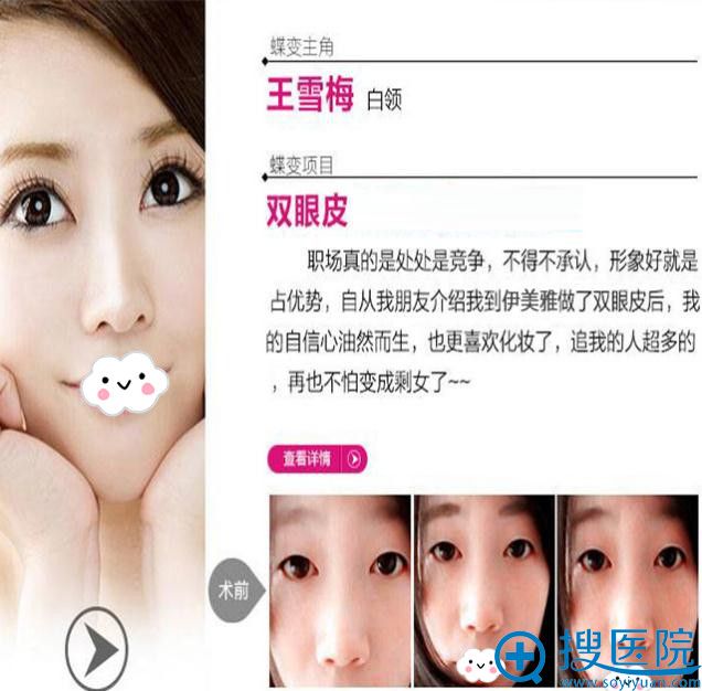<!--<i data=20240710 data-id=9126></i>-->双眼皮真人效果前后对比 <!--<i data=20240710 data-id=9126></i>-->双眼皮真人效果前后对比