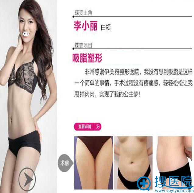 <!--<i data=20240710 data-id=9126></i>-->吸脂塑形效果好吗 <!--<i data=20240710 data-id=9126></i>-->吸脂塑形效果好吗