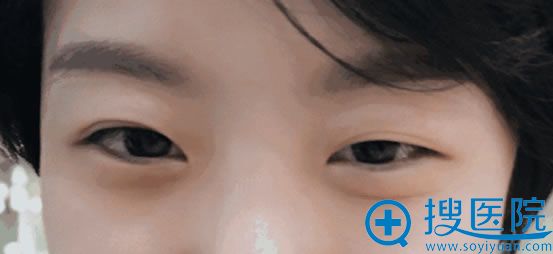 做双眼皮手术前不对称的单眼皮 做双眼皮手术前不对称的单眼皮