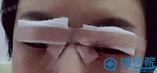 刚做完双眼皮开眼角的照片 刚做完双眼皮开眼角的照片
