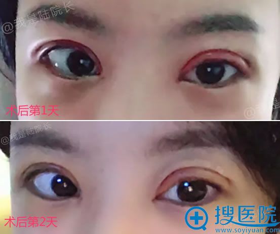 黑龙江瑞丽双眼皮术后2天 黑龙江瑞丽双眼皮术后2天