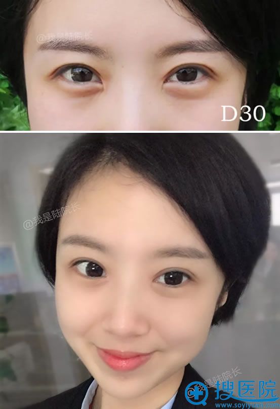 找黑龙江瑞丽李云峰做开眼角30天后 找黑龙江瑞丽李云峰做开眼角30天后