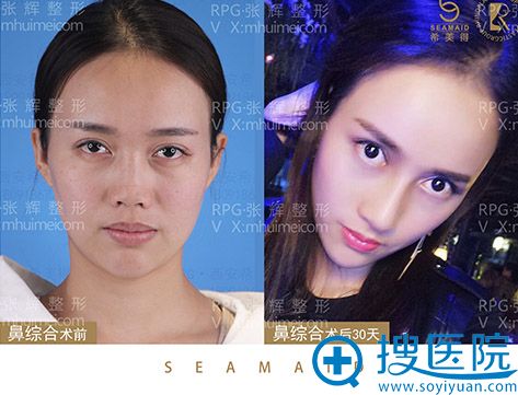 西安希美得医疗美容鼻综合案例 西安希美得医疗美容鼻综合案例