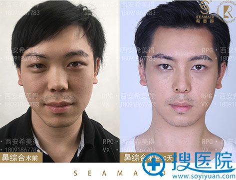 西安希美得医疗美容鼻综合案例 西安希美得医疗美容鼻综合案例