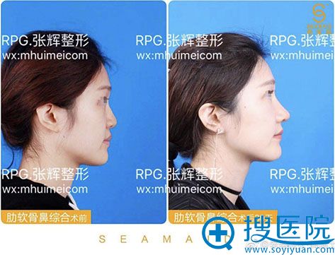 西安希美得医疗美容鼻综合案例 西安希美得医疗美容鼻综合案例