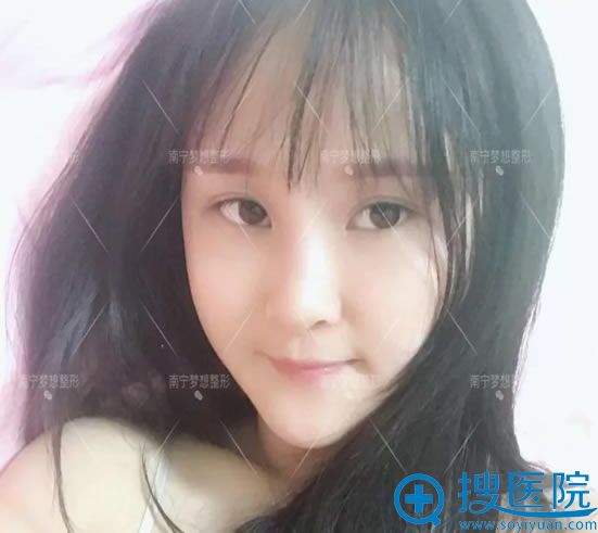 在南宁梦想做自体脂肪填充7天后 在南宁梦想做自体脂肪填充7天后