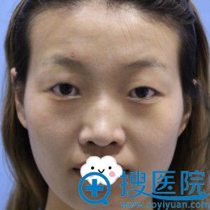 我的颜值差不愿与人合拍 无耐到福州比华利做双眼皮后逆转了