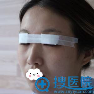 福州比华利双眼皮+开眼角案例 福州比华利双眼皮+开眼角案例
