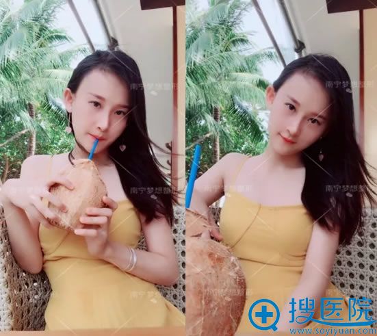 做自体脂肪填充全脸术后30天 做自体脂肪填充全脸术后30天