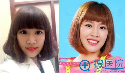 北京丽都石冰自体脂肪填充案例 北京丽都石冰自体脂肪填充案例