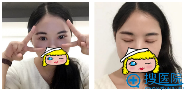 河南整形美容医院聂丽丽小清新双眼皮案例一个月效果图 河南整形美容医院聂丽丽小清新双眼皮案例一个月效果图