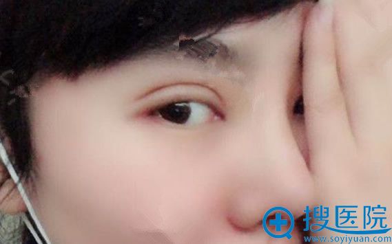 瑞丽整形医院双眼皮+隆鼻失败修复第9天恢复效果 瑞丽整形医院双眼皮+隆鼻失败修复第9天恢复效果