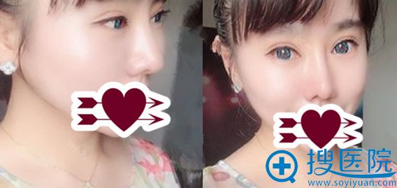 隆鼻失败修复+双眼皮修复术后第54天效果图 隆鼻失败修复+双眼皮修复术后第54天效果图