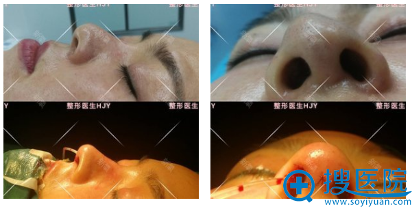 <!--<i data=20240710 data-id=11816></i>-->黄见勇肋软骨隆鼻术后即刻效果图 <!--<i data=20240710 data-id=11816></i>-->黄见勇肋软骨隆鼻术后即刻效果图