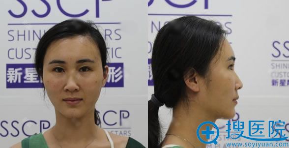 做完自体脂肪填充面部7天效果 做完自体脂肪填充面部7天效果