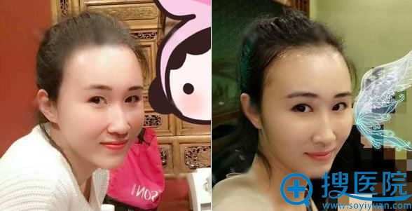 做完脂肪填充术后5个月效果 做完脂肪填充术后5个月效果