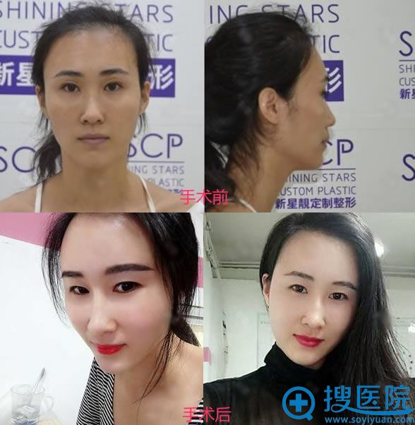 自体脂肪填充8个月效果对比图 自体脂肪填充8个月效果对比图