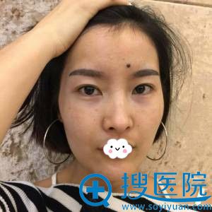 深圳金立自体脂肪面部填充+双眼皮真人案例 深圳金立自体脂肪面部填充+双眼皮真人案例