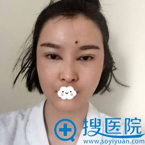 深圳金立自体脂肪丰面+双眼皮+开眼角案例 深圳金立自体脂肪丰面+双眼皮+开眼角案例