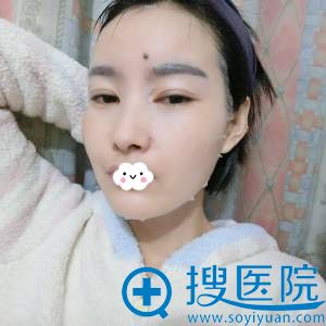 深圳金立双眼皮+开眼角效果好吗 深圳金立双眼皮+开眼角效果好吗
